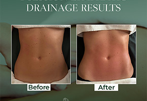 Woman's abdomen before and after lymphatic drainage